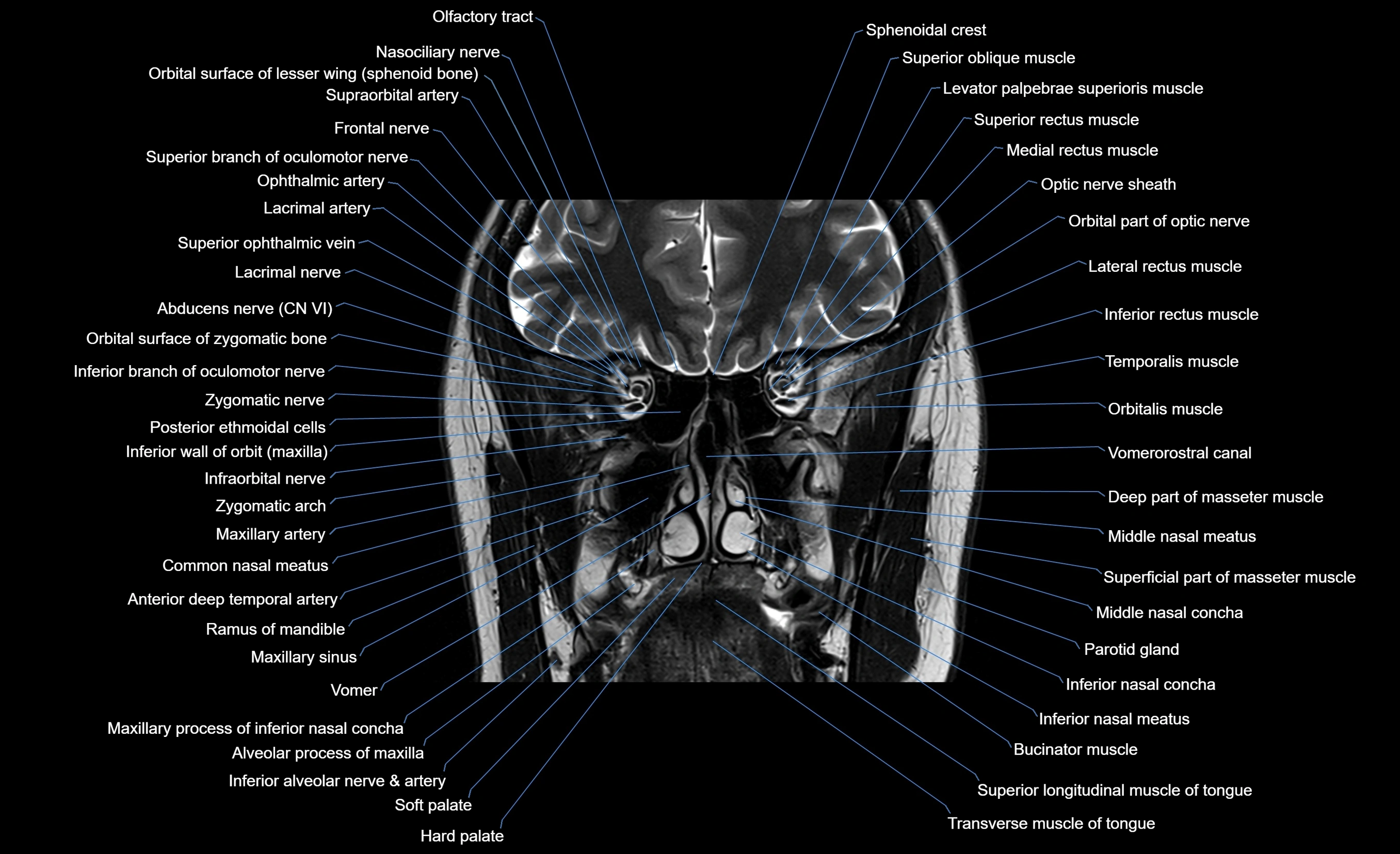 MRI face & paranasal sinuses(PNS) labelled  coronal  cross sectional anatomy 3T radiology  image-img-00001-00027.webp